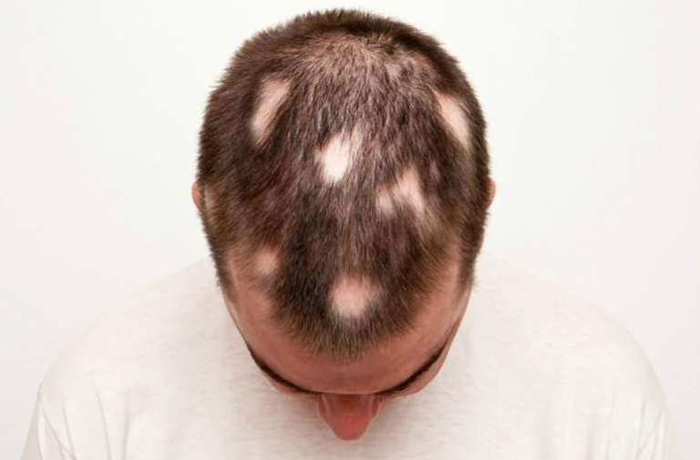 alopesi areta