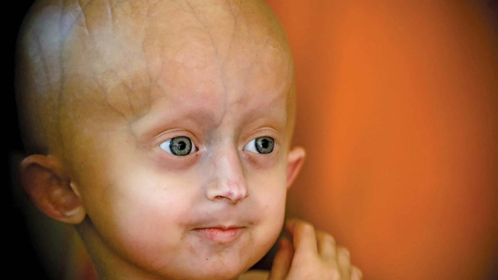 progeria sendromu