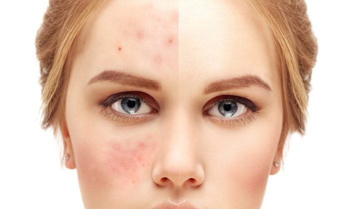 acne-e1592402959233