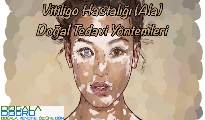 vitiligo-kapak-